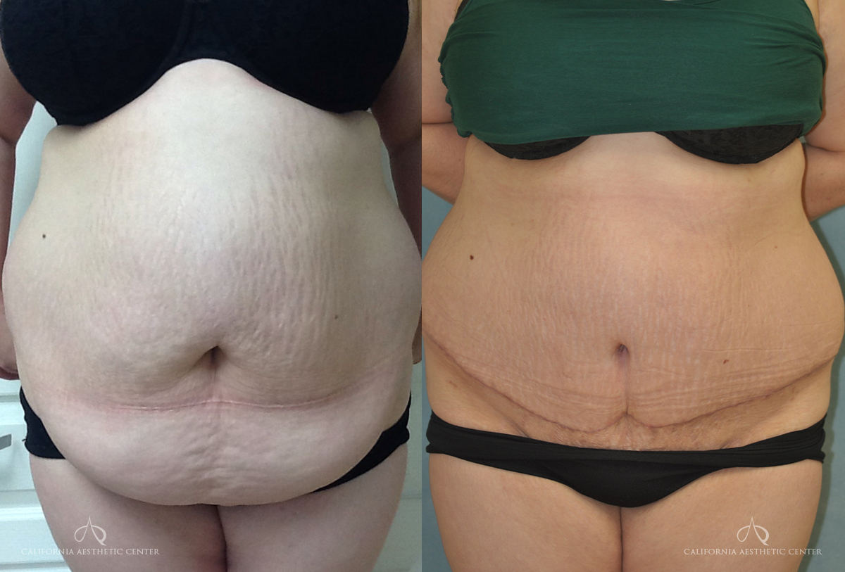 Patient 8 Panniculectomy Side Before and After