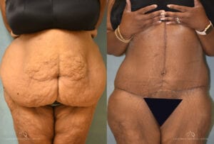 Patient 9 Panniculectomy Front Before and After