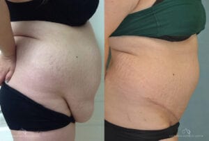 Patient 8 Panniculectomy Side Before and After
