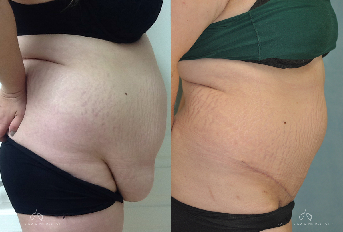 Panniculectomy Before and After Photos