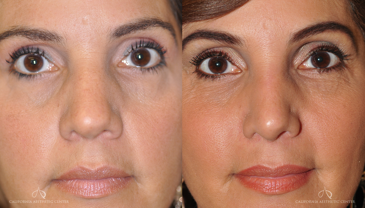 Patient 4 Rhinoplasty Front Before and After