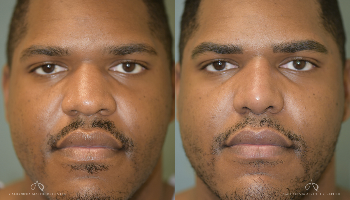 Patient 5 Rhinoplasty Before and After Front