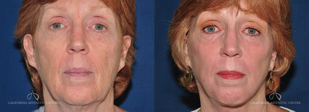 Patient 4 Facelift Front Before and After