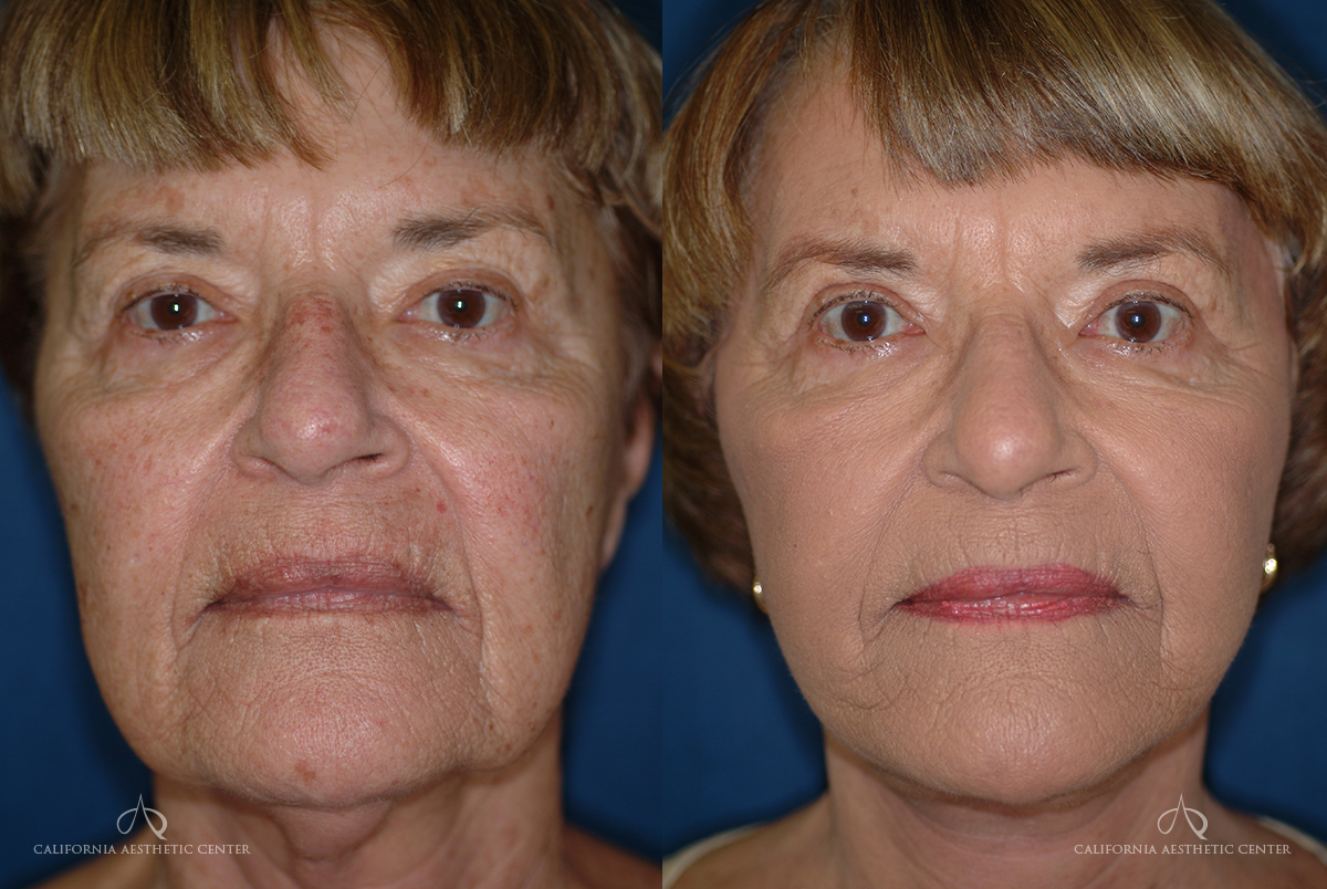 Patient 51 - Facelift Front Before and After
