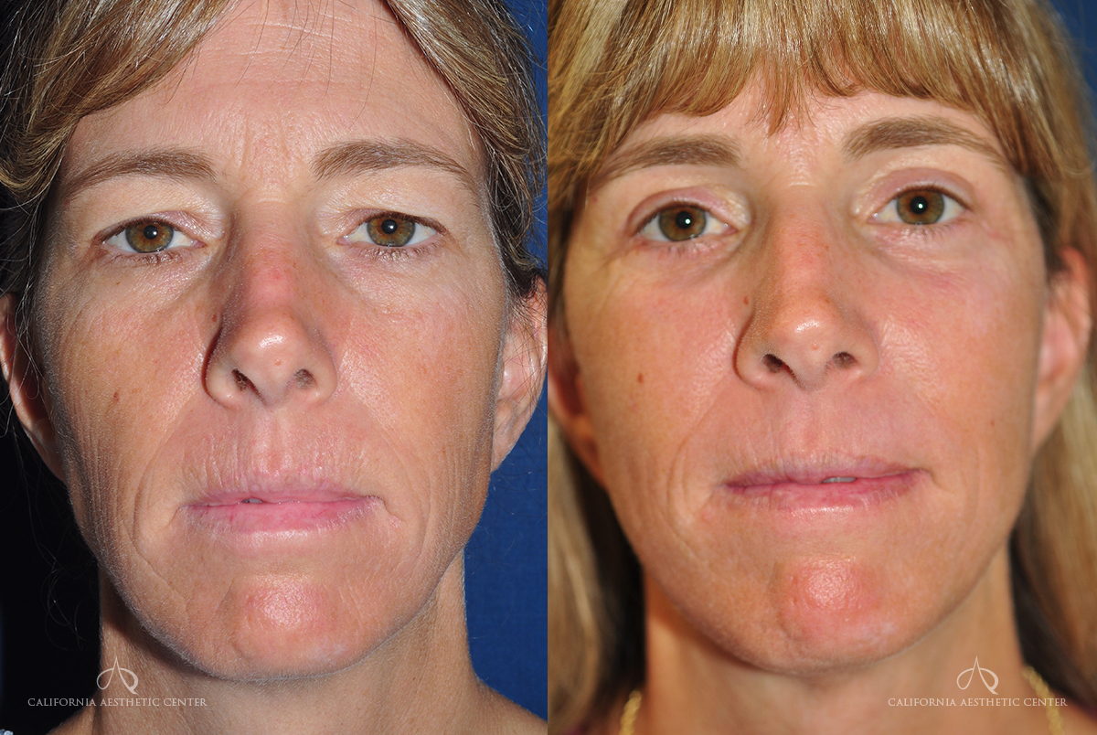 Patient 6 - Facelift Front Before and After