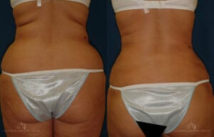 Patient 3 Liposuction Back Before and After