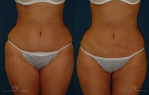 Patient 3 Liposuction Front Before and After