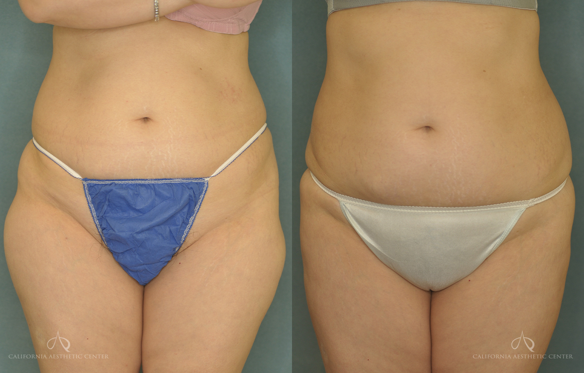 Patient 4 Before and After Liposuction Front View