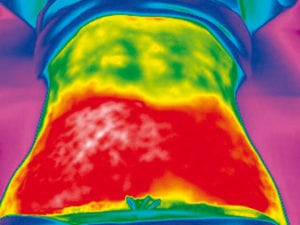 Vanquish Post Procedure Thermography Scan