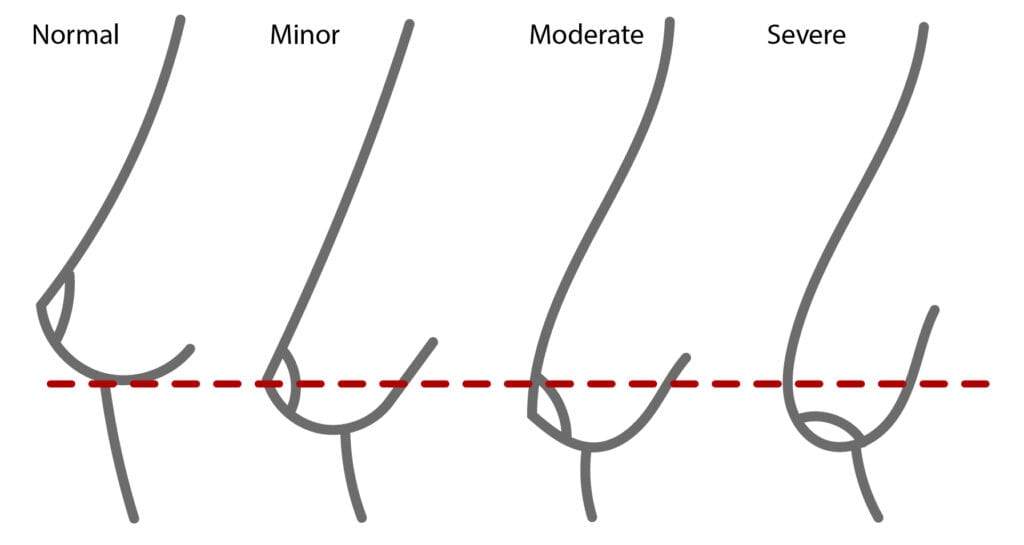 Diagram showing the variations of sagging breasts