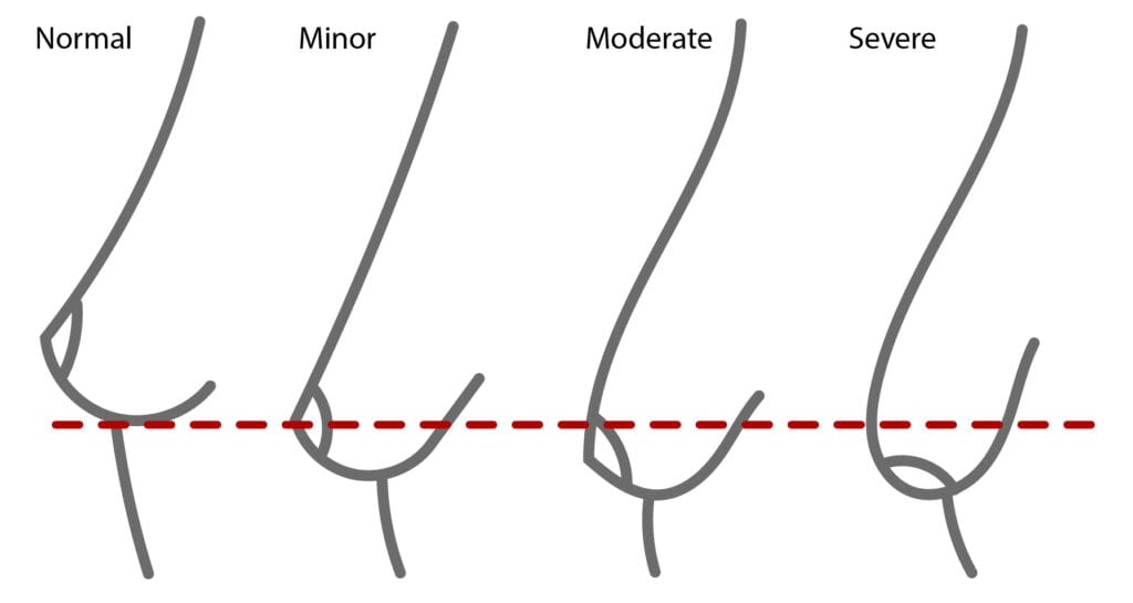 Breast Lift in Irvine, CA