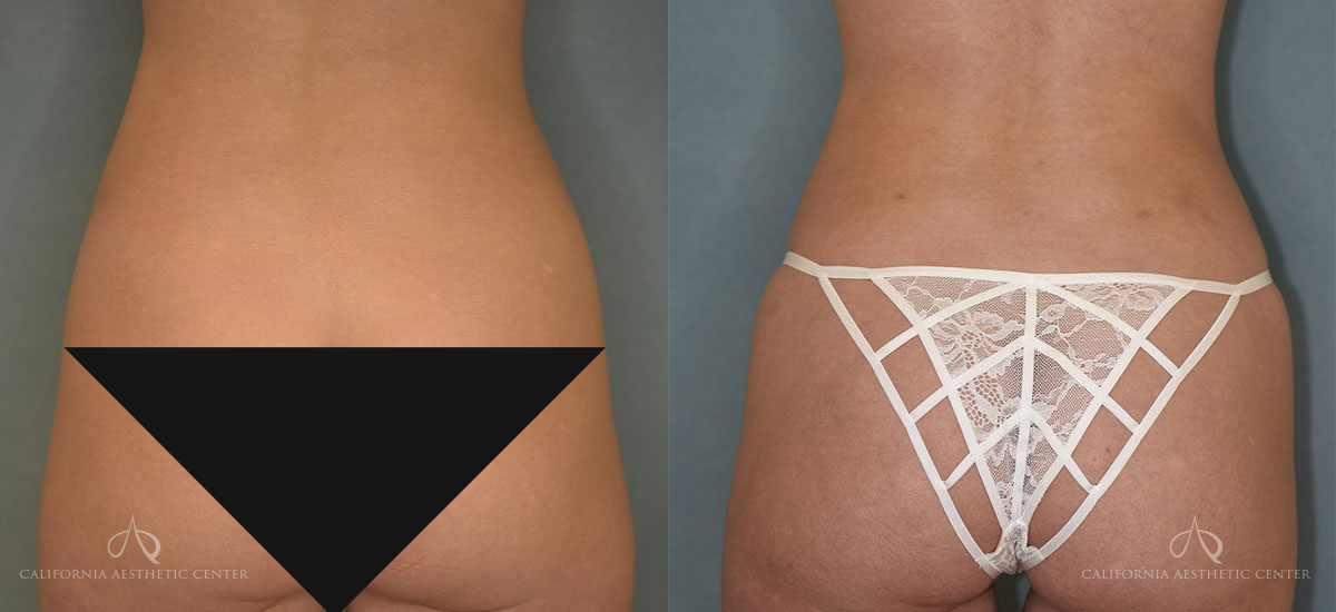 Before & After of Dr. Vu's Liposuction Patient