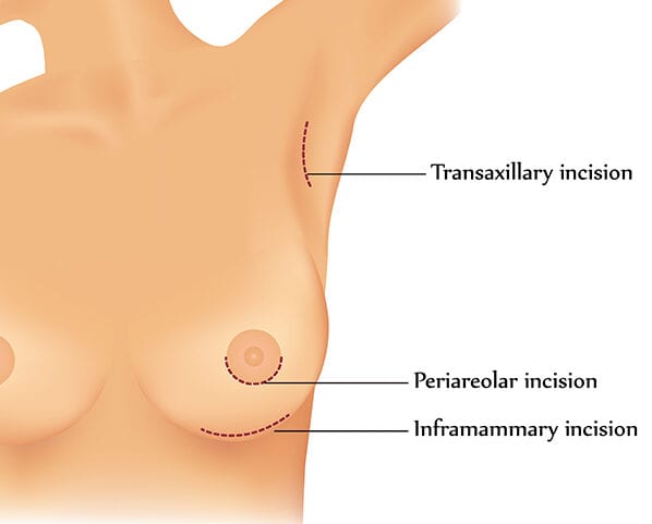 stevevu breast implant options graphic