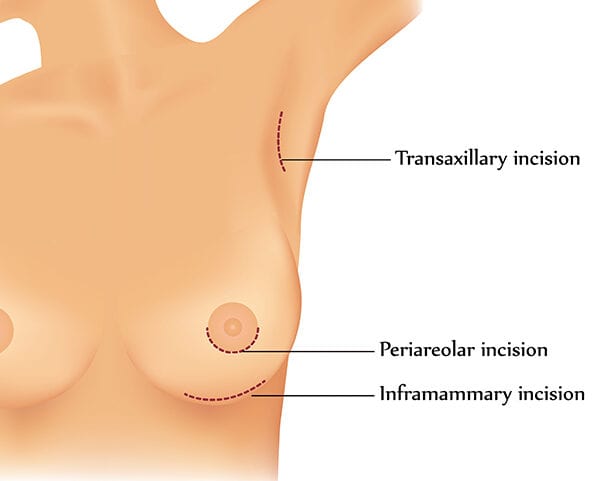 TEARDROP (ANATOMICALLY) SHAPED BREAST IMPLANTS - Orange County, CA