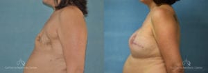 Breast Reconstruction Before and After Photos Patient 1A