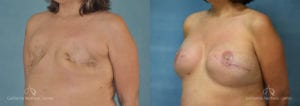 Breast Reconstruction Before and After Photos Patient 1B