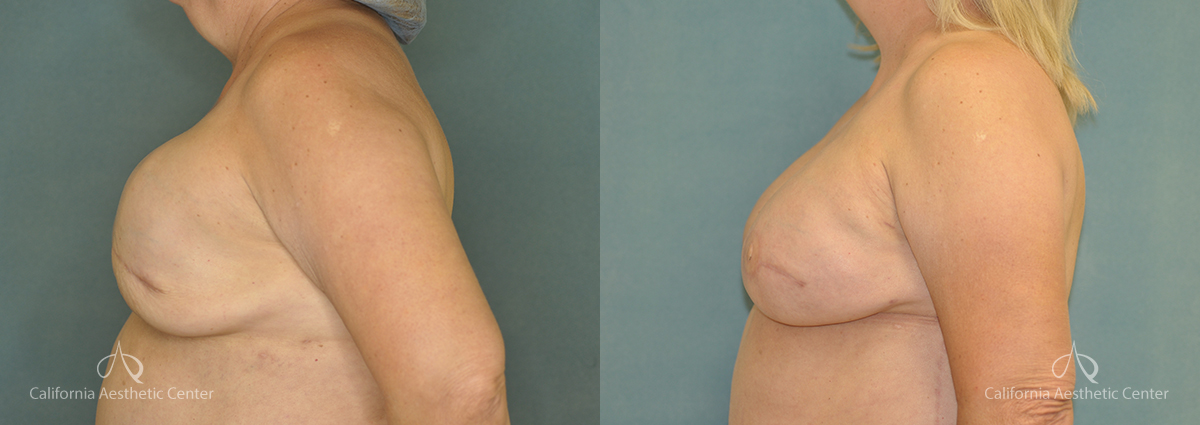 Breast Reconstruction Before and After Photos Patient 2A