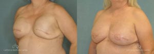 Breast Reconstruction Before and After Photos Patient 2B