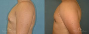 Gynecomastia Before and After Photos Patient 1A