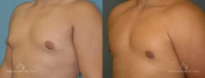 Gynecomastia Before and After Photos Patient 1B
