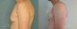 Gynecomastia Before and After Photos Patient 2A