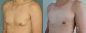 Gynecomastia Before and After Photos Patient 2B