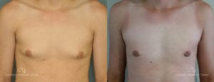 Gynecomastia Before and After Photos Patient 2C