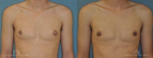 Patient 3 Gynecomastia Before and After Front Chest View