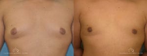 Patient 1 Gynecomastia Before and After Front View
