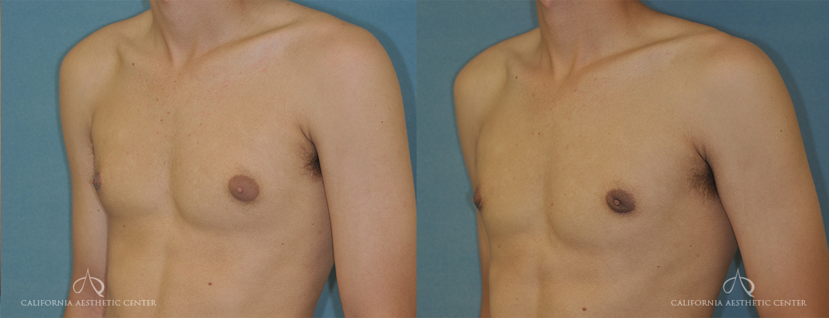 Patient 3 Gynecomastia Before and After Left Oblique Chest View