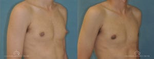 Patient 3 Gynecomastia Before and After Right Oblique Chest View
