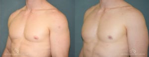 Patient 4 Gynecomastia Before and After Left Oblique Chest View