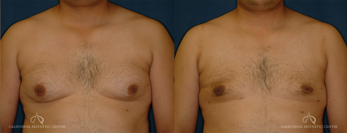 Patient 6 - Gynecomastia Oblique Before and After
