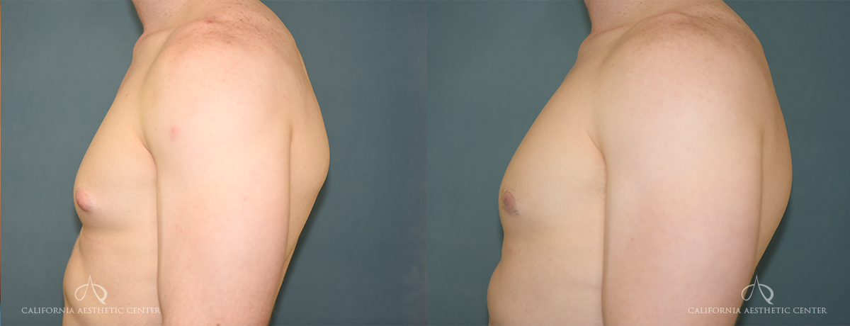 Patient 4 Gynecomastia Before and After Left Side Chest View