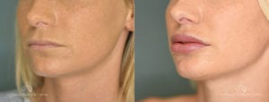 Lip Filler Before and After Patient 1A