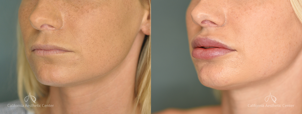 Lip Filler & Lip Augmentation - Lip Enhancement - The Aesthetics Doctor