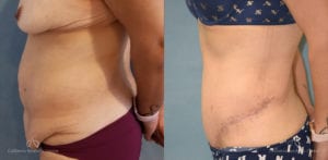 Panniculectomy Before and After Photos Patient 1B