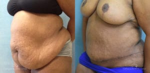 Panniculectomy Before and After Photos Patient 2A
