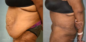Panniculectomy Before and After Photos Patient 3A
