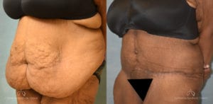 Panniculectomy Before and After Photos Patient 3B