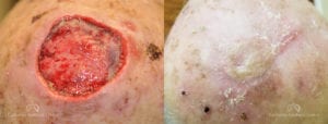 Skin Graft Before and After Photos Patient 1A