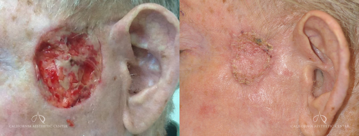 Patient 3 Skin Graft Side Before and After