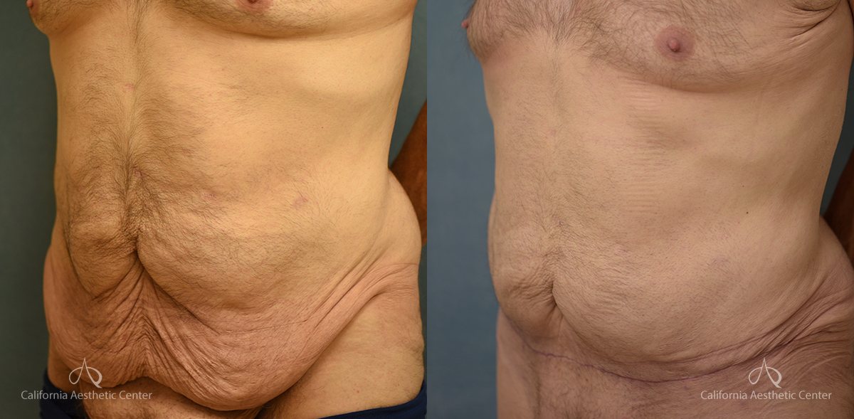 Panniculectomy Before and After Photos Patient 4B