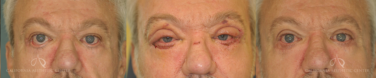 Patient 9 Blepharoplasty Before and After Front
