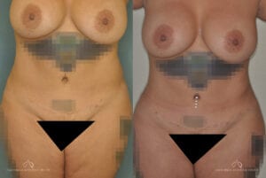 Patient 4 Brazilian Butt Lift Before and After Front