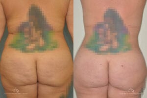 Patient 4 Brazilian Butt Lift Before and After Back