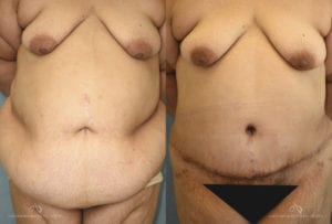 Patient 7 Panniculectomy Before and After Front View
