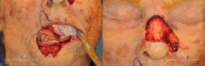Patient 2 Skin Flap Excision Before and After