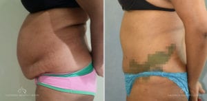 Patient 16 Abdominoplasty Before and After Left Side View