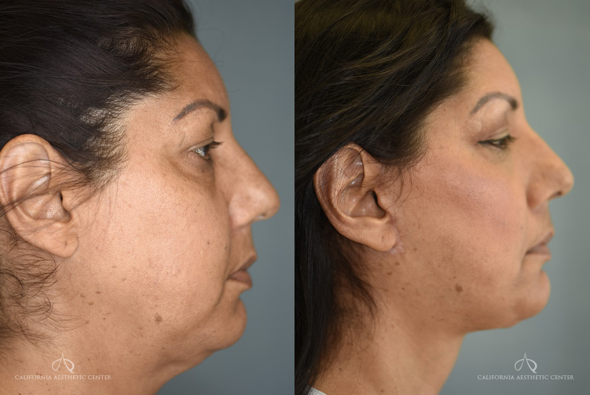 SKIN TIGHTENING Before After Photos Orange County CA